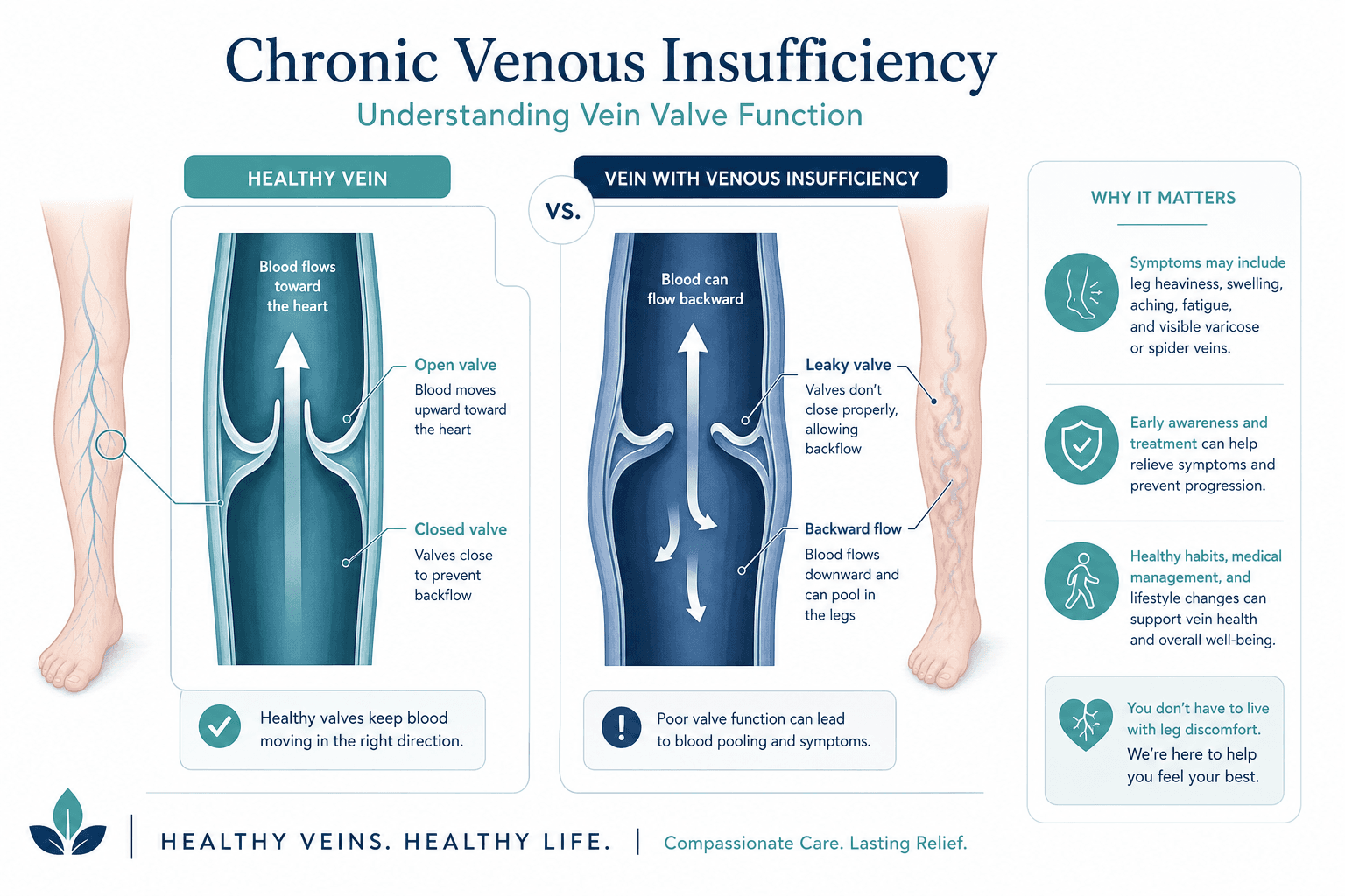 Medical illustration showing venous insufficiency in leg veins, New York vein treatment