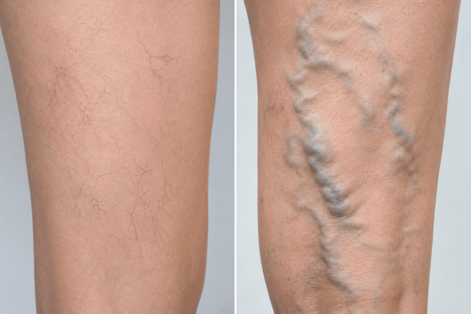 Spider veins vs varicose veins side-by-side comparison of size depth and treatment options