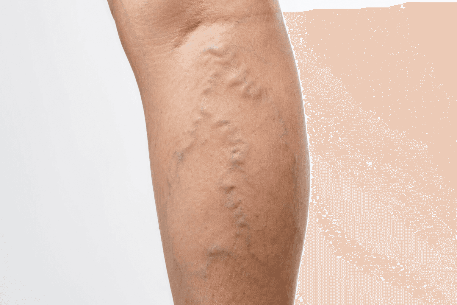Close-up of leg showing varicose and reticular vein patterns