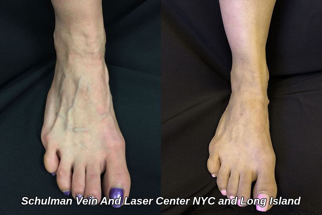 Foot Veins – Before & After