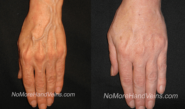Hand Veins – Before & After