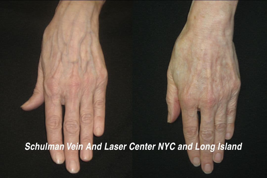 Hand Veins – Before & After