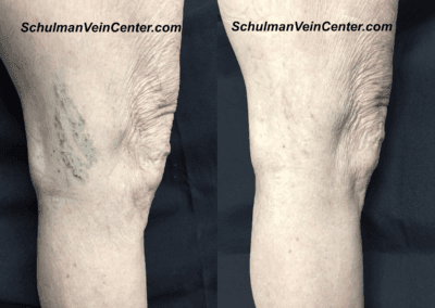 Spider Veins – Patient 7